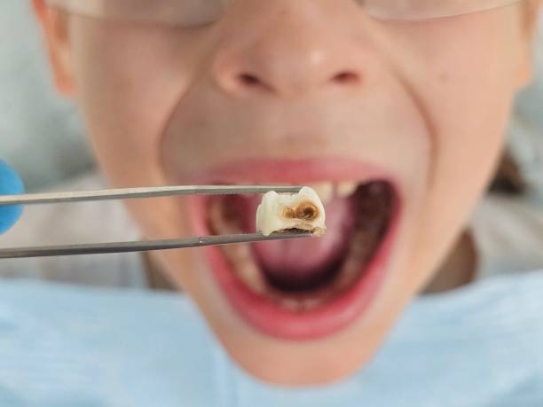 Best Emergency Dental Care for Abscessed Tooth in Johnston City, IL